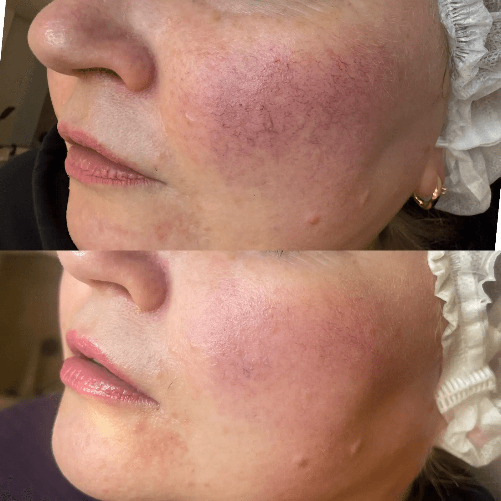 ФОТОТЕРАПИЯ IPL (удаление сосудов)