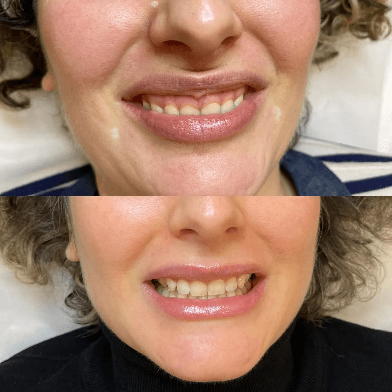 КОРРЕКЦИЯ ГИНГИВАЛЬНОЙ УЛЫБКИ