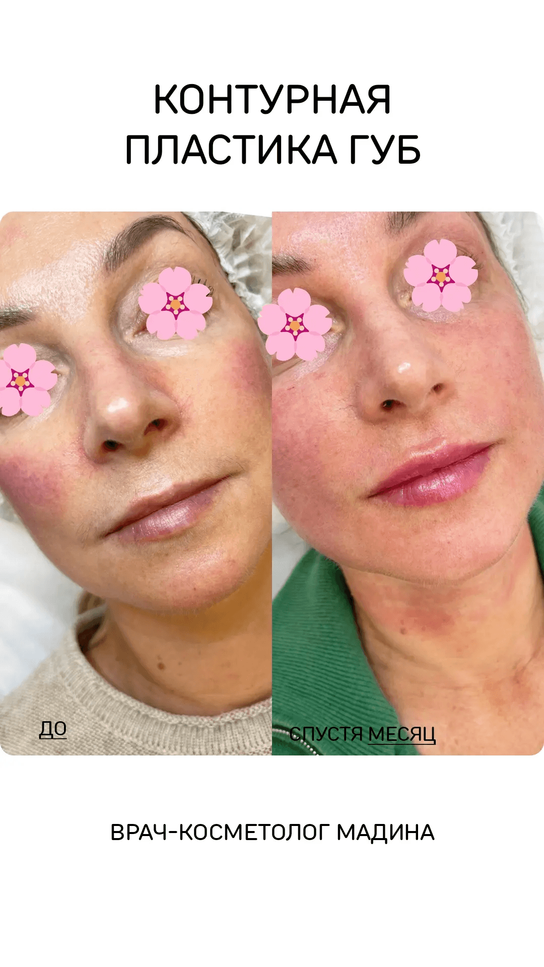 КОНТУРНАЯ ПЛАСТИКА ГУБ