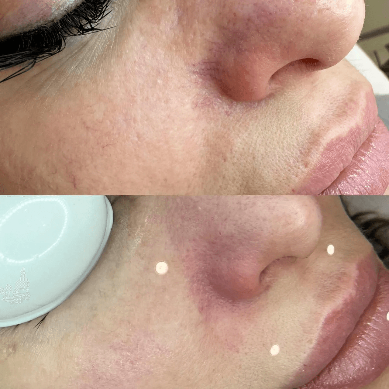 ФОТОТЕРАПИЯ IPL (удаление сосудов)