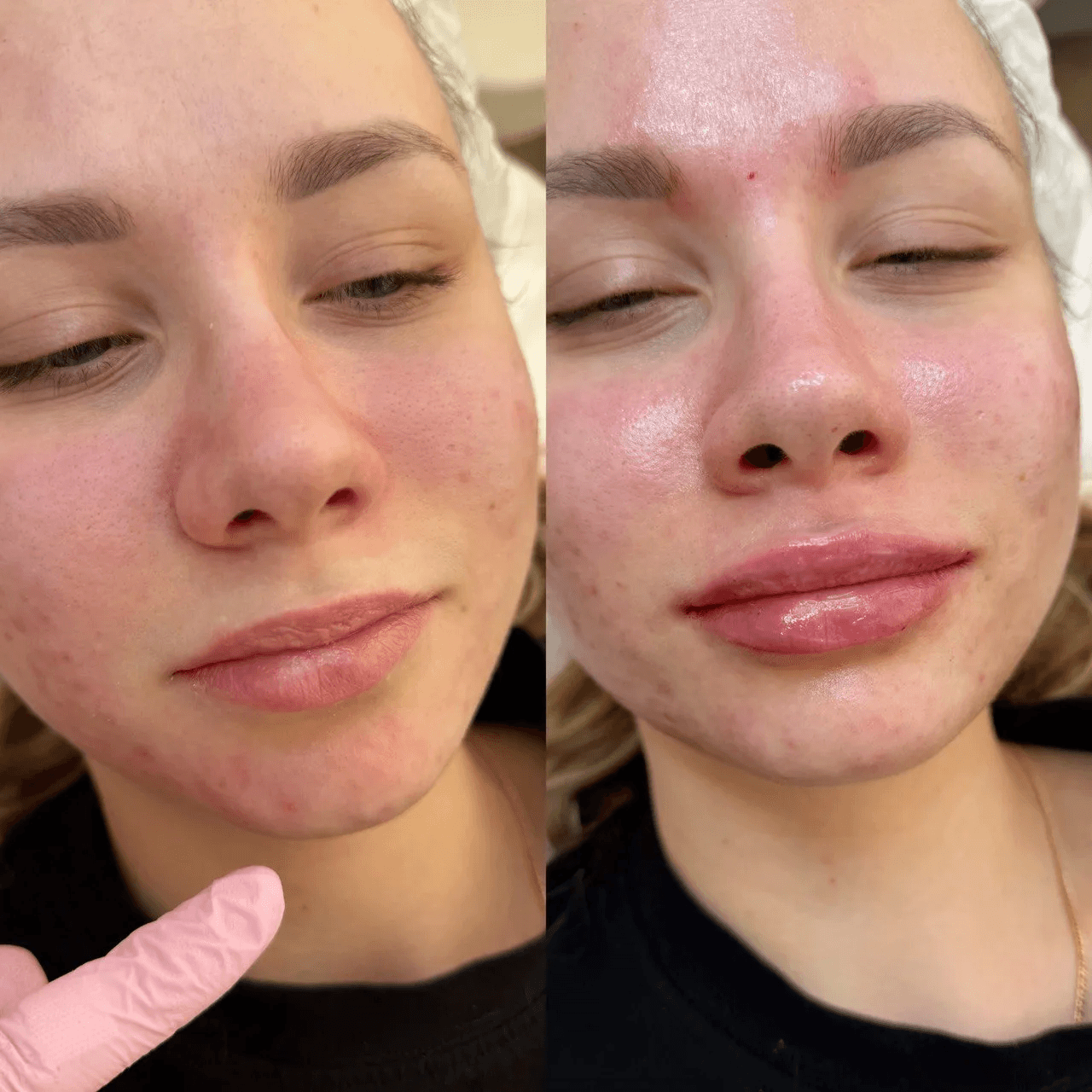 КОНТУРНАЯ ПЛАСТИКА ГУБ