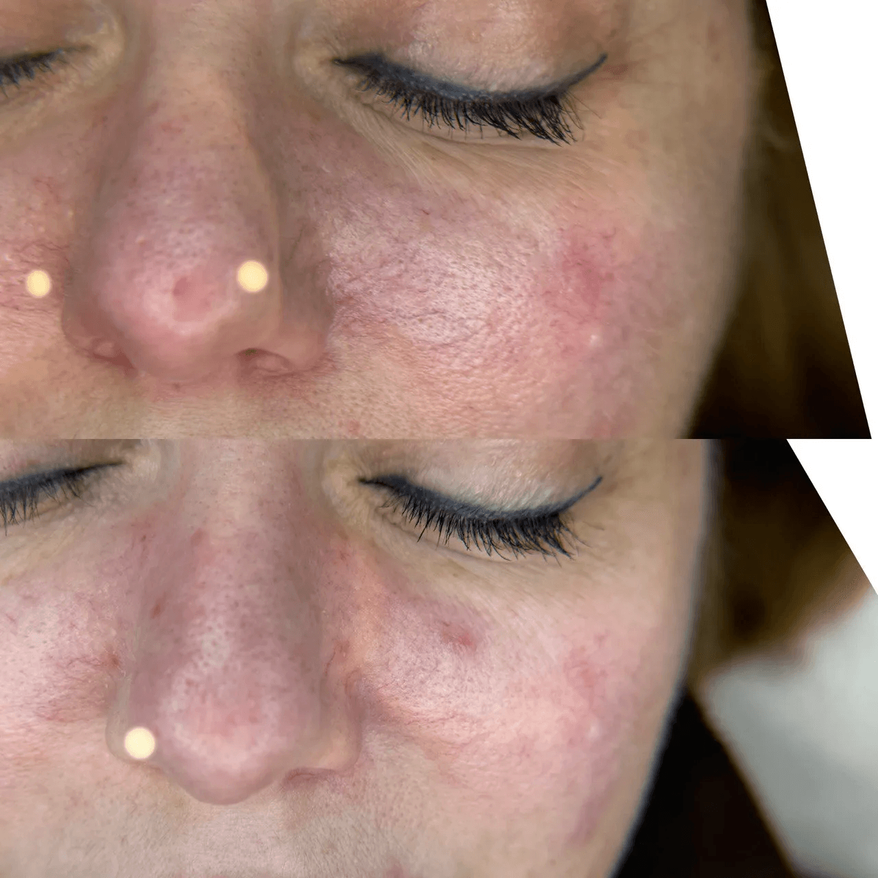 ФОТОТЕРАПИЯ IPL (удаление сосудов)