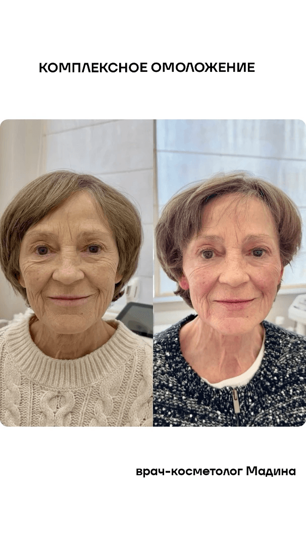 КОМПЛЕКСНОЕ ОМОЛОЖЕНИЕ