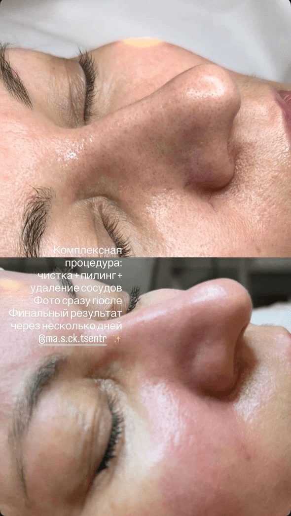 ЧИСТКА ЛИЦА + ПИЛИНГ