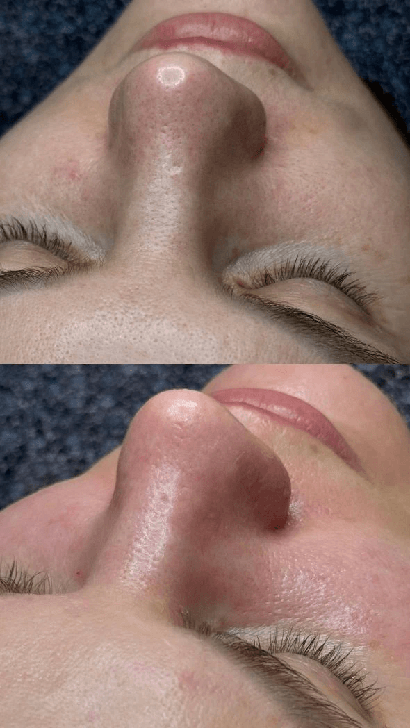 ЧИСТКА ЛИЦА + ПИЛИНГ