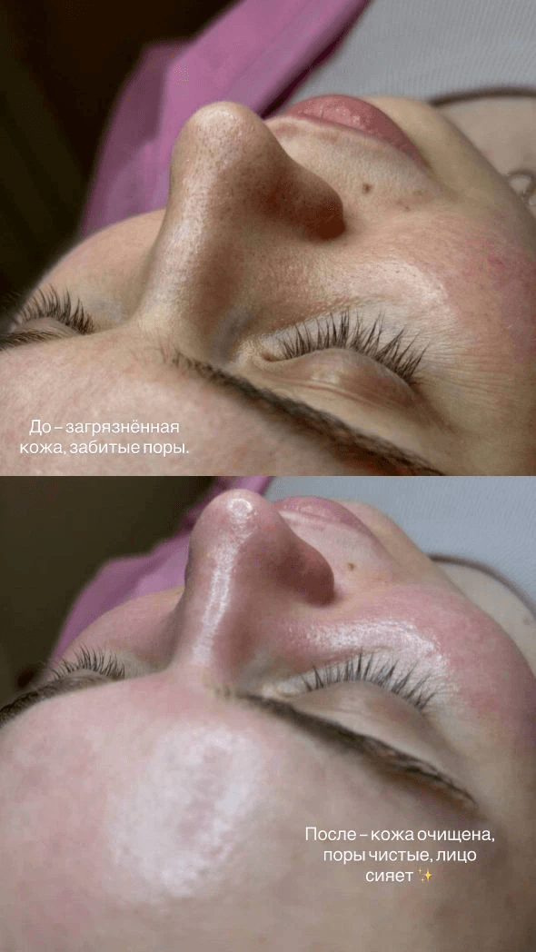 ЧИСТКА ЛИЦА + ПИЛИНГ