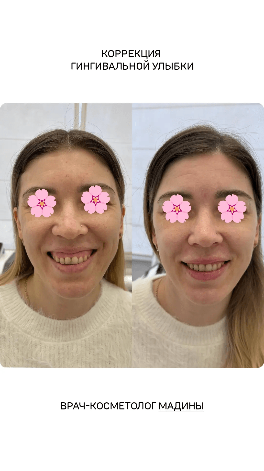 КОРРЕКЦИЯ ГИНГИВАЛЬНОЙ УЛЫБКИ