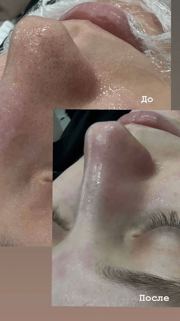 ЧИСТКА ЛИЦА + ПИЛИНГ