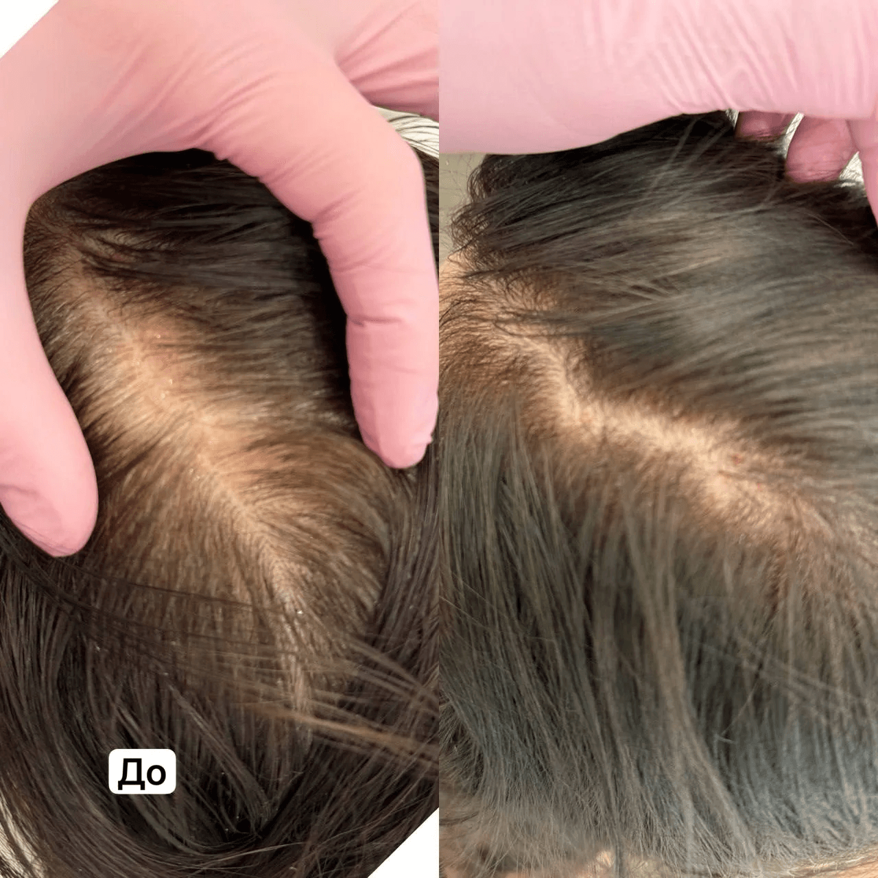 PRP-ТЕРАПИЯ ВОЛОСИСТОЙ ЧАСТИ ГОЛОВЫ