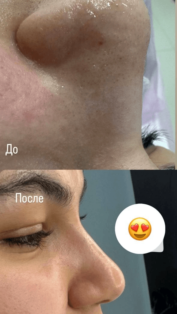 ЧИСТКА ЛИЦА + ПИЛИНГ