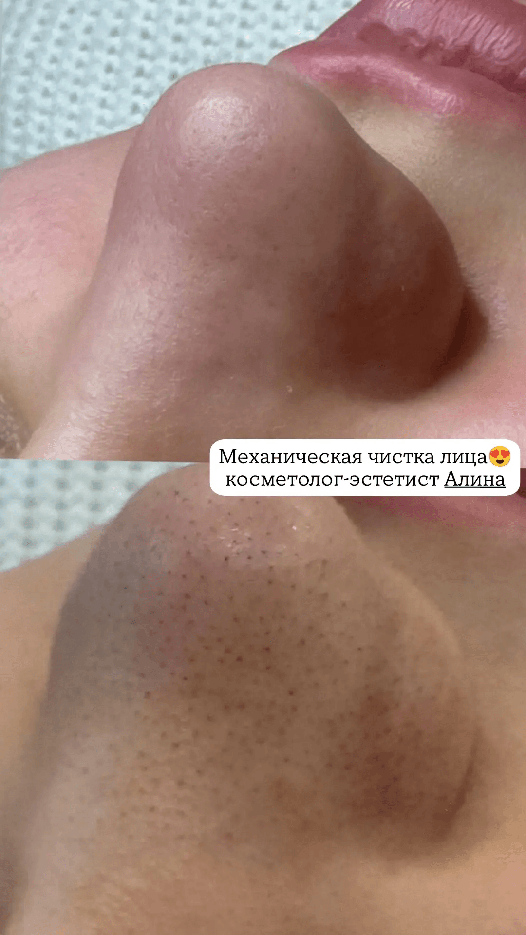 ЧИСТКА ЛИЦА + ПИЛИНГ