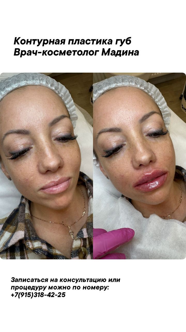 КОНТУРНАЯ ПЛАСТИКА ГУБ