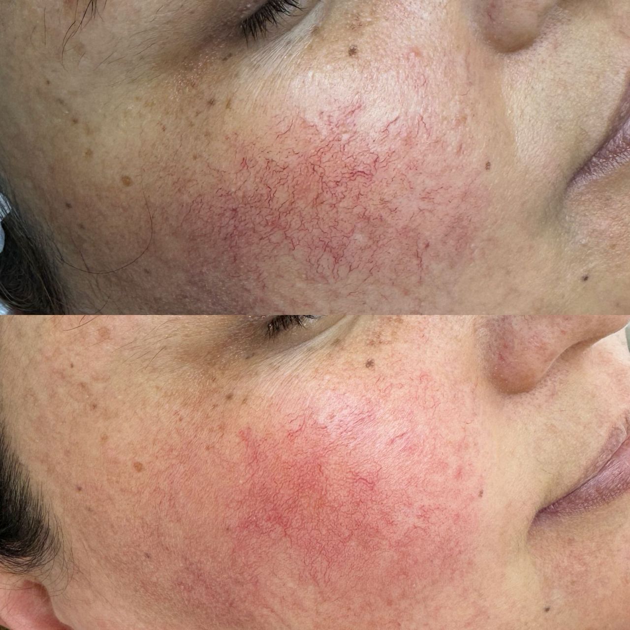 ФОТОТЕРАПИЯ IPL (удаление сосудов)