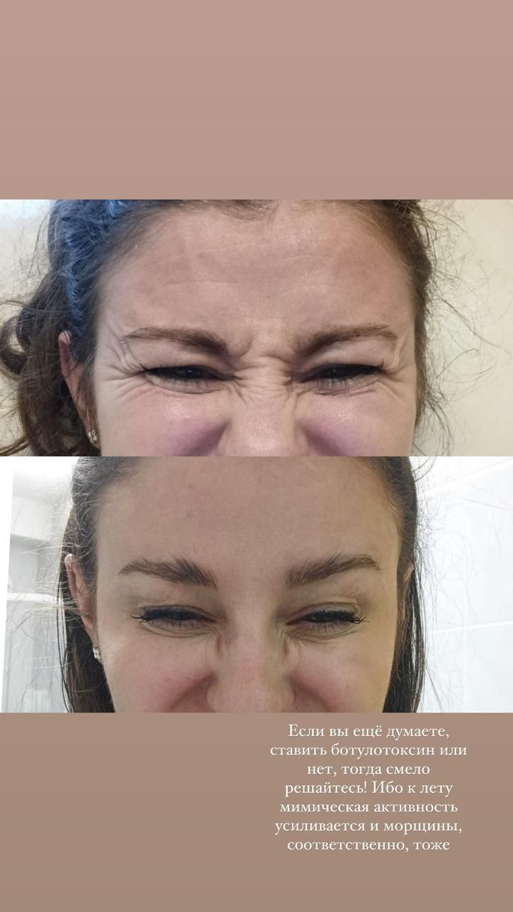 УСТРАНЕНИЕ МОРЩИН БОТУЛОТОКСИНОМ