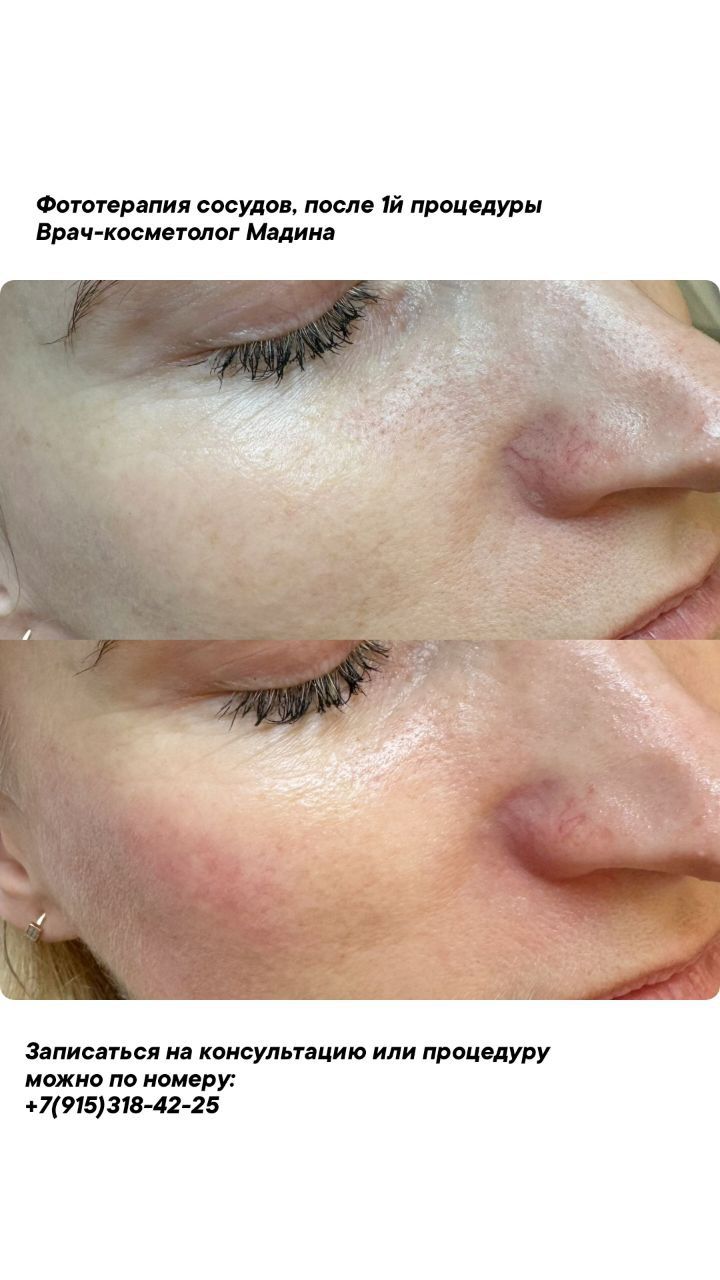 ФОТОТЕРАПИЯ IPL (удаление сосудов)