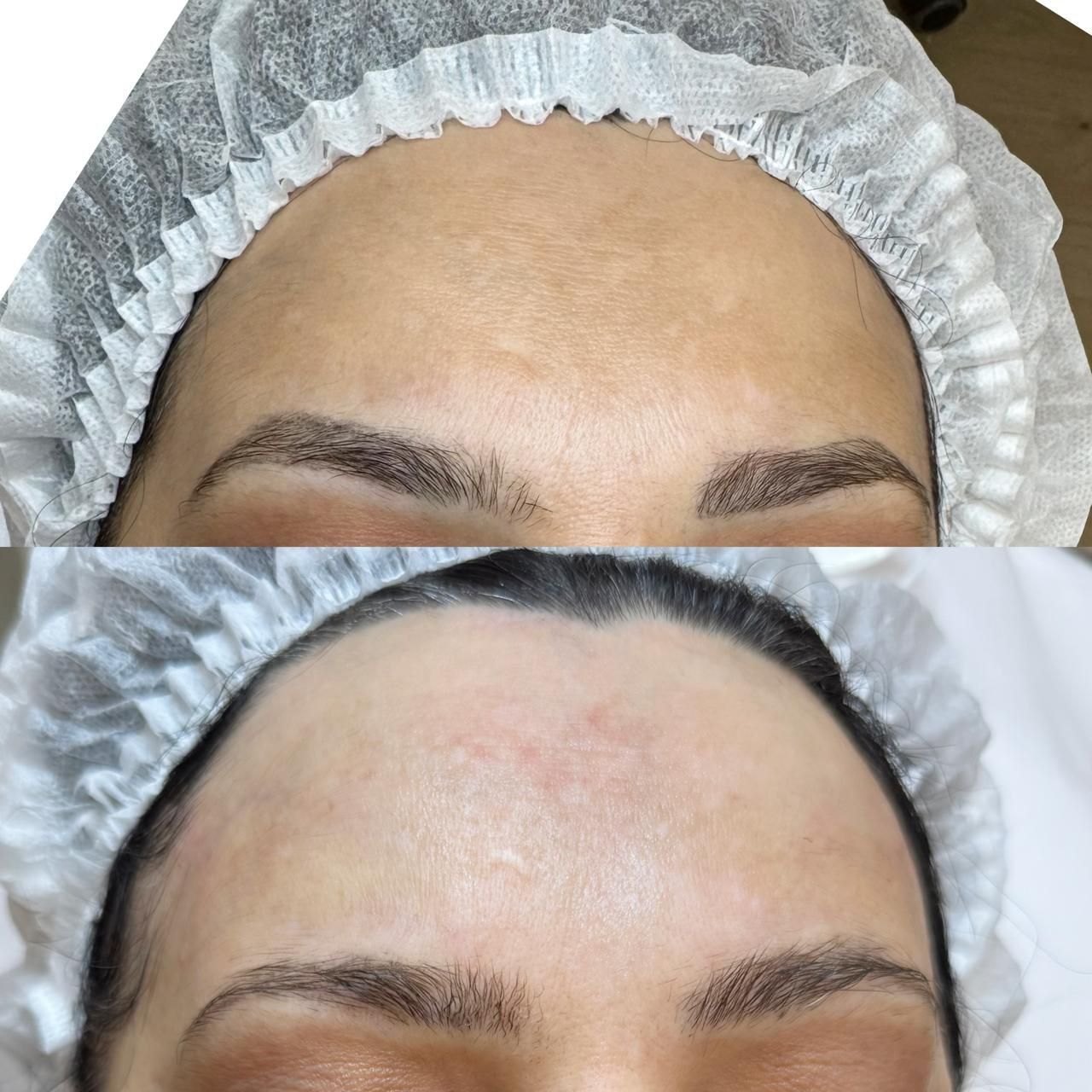 ФОТОТЕРАПИЯ IPL (удаление пигментации)