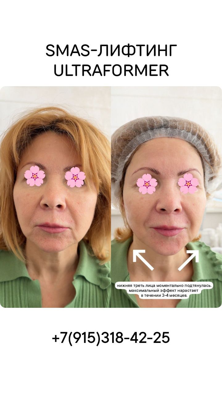 SMAS-ЛИФТИНГ ULTRAFORMER